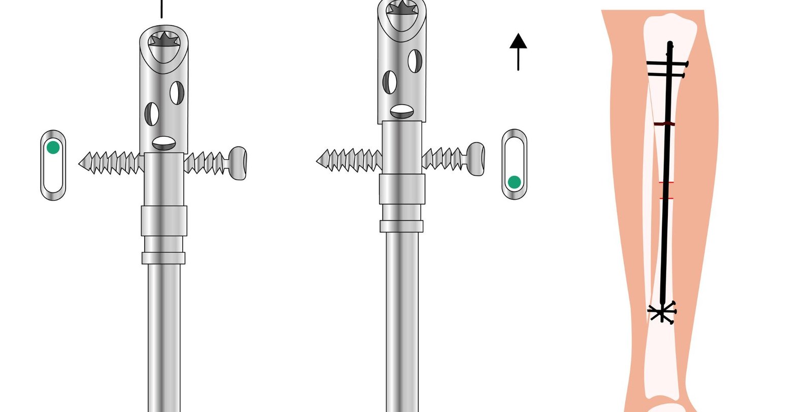 Limb Lengthening Surgery